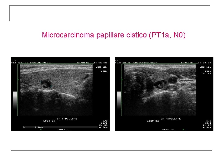 Microcarcinoma papillare cistico (PT 1 a, N 0) Microcarcinoma papillare cistico (PT 1 a, N 0)