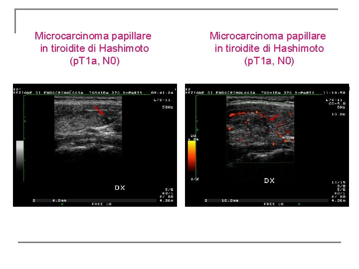 Microcarcinoma papillare in tiroidite di Hashimoto (p. T 1 a, N 0) Microcarcinoma papillare in tiroidite di Hashimoto (p. T 1 a, N 0)