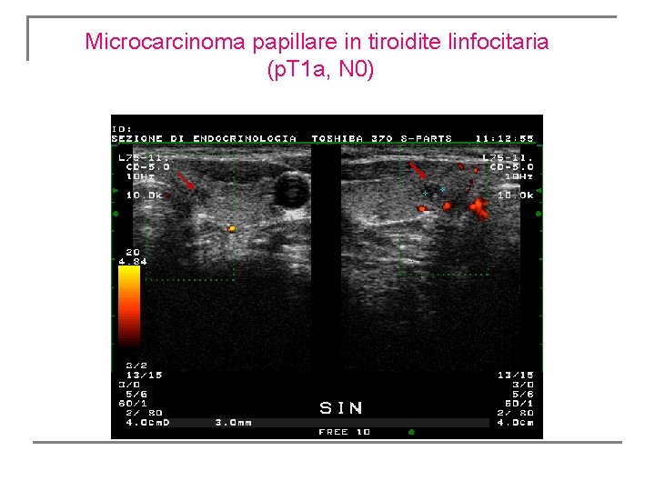 Microcarcinoma papillare in tiroidite linfocitaria (p. T 1 a, N 0) Microcarcinoma papillare in tiroidite linfocitaria (p. T 1 a, N 0)