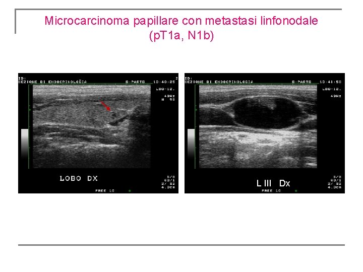 Microcarcinoma papillare con metastasi linfonodale (p. T 1 a, N 1 b) L III Microcarcinoma papillare con metastasi linfonodale (p. T 1 a, N 1 b) L III