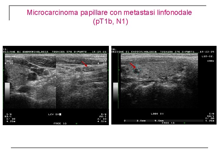Microcarcinoma papillare con metastasi linfonodale (p. T 1 b, N 1) Microcarcinoma papillare con metastasi linfonodale (p. T 1 b, N 1)