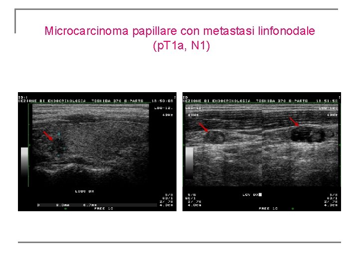 Microcarcinoma papillare con metastasi linfonodale (p. T 1 a, N 1) Microcarcinoma papillare con metastasi linfonodale (p. T 1 a, N 1)