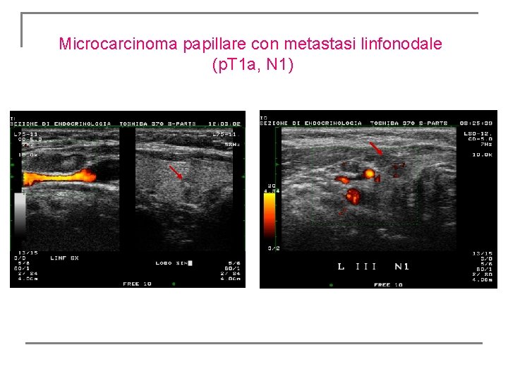 Microcarcinoma papillare con metastasi linfonodale (p. T 1 a, N 1) Microcarcinoma papillare con metastasi linfonodale (p. T 1 a, N 1)