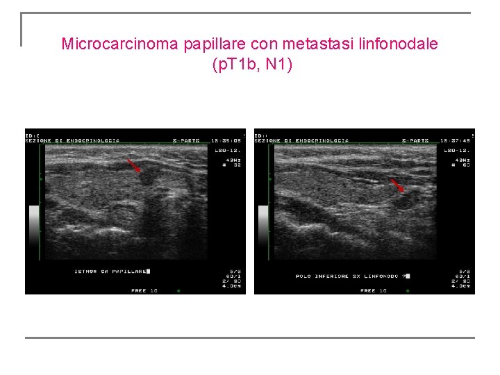 Microcarcinoma papillare con metastasi linfonodale (p. T 1 b, N 1) Microcarcinoma papillare con metastasi linfonodale (p. T 1 b, N 1)