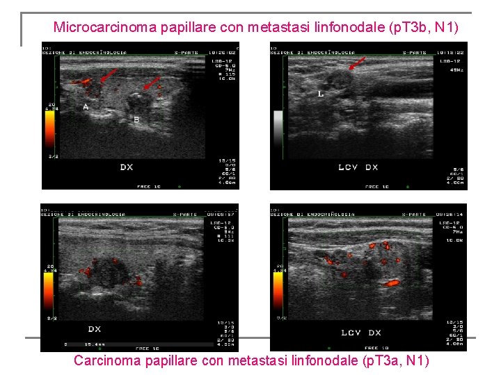 Microcarcinoma papillare con metastasi linfonodale (p. T 3 b, N 1) L II Carcinoma Microcarcinoma papillare con metastasi linfonodale (p. T 3 b, N 1) L II Carcinoma