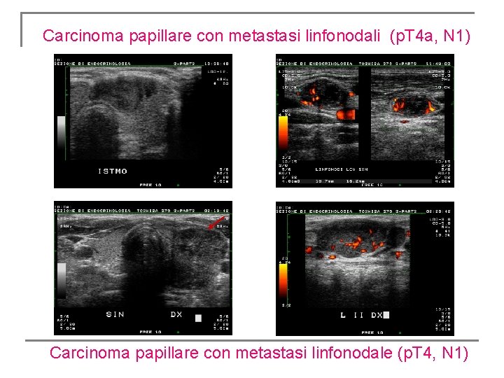 Carcinoma papillare con metastasi linfonodali (p. T 4 a, N 1) Carcinoma papillare con Carcinoma papillare con metastasi linfonodali (p. T 4 a, N 1) Carcinoma papillare con