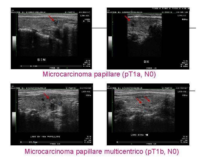 Microcarcinoma papillare (p. T 1 a, N 0) Microcarcinoma papillare multicentrico (p. T 1 Microcarcinoma papillare (p. T 1 a, N 0) Microcarcinoma papillare multicentrico (p. T 1