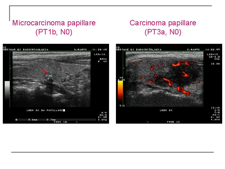 Microcarcinoma papillare (PT 1 b, N 0) Carcinoma papillare (PT 3 a, N 0) Microcarcinoma papillare (PT 1 b, N 0) Carcinoma papillare (PT 3 a, N 0)