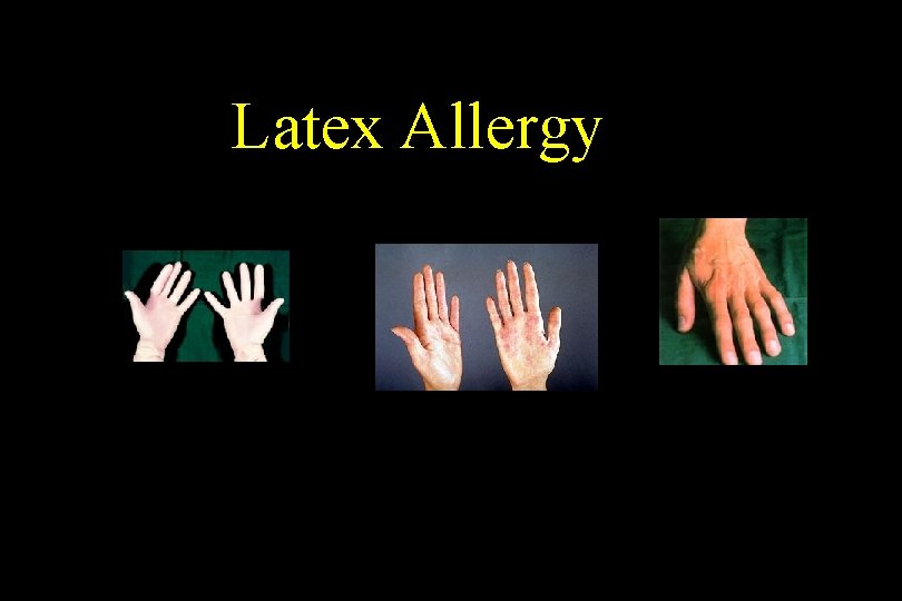 Latex Allergy 