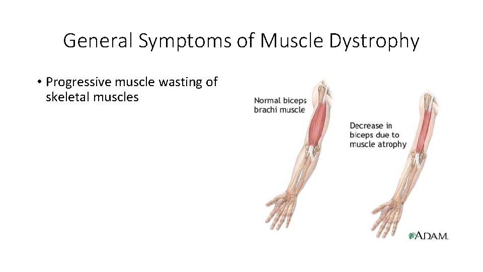 General Symptoms of Muscle Dystrophy • Progressive muscle wasting of skeletal muscles 