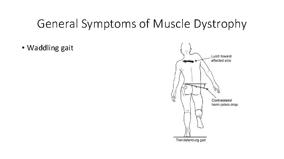 General Symptoms of Muscle Dystrophy • Waddling gait 