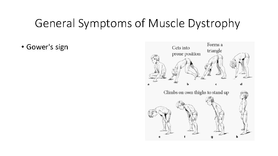 General Symptoms of Muscle Dystrophy • Gower's sign 