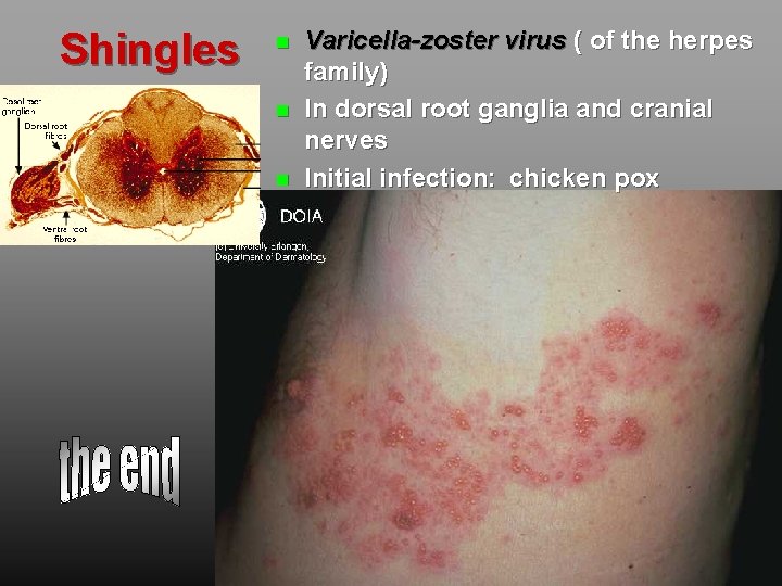 Shingles Varicella-zoster virus ( of the herpes family) In dorsal root ganglia and cranial