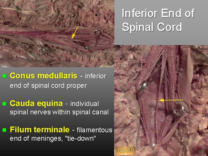 Inferior End of Spinal Cord Conus medullaris - inferior end of spinal cord proper