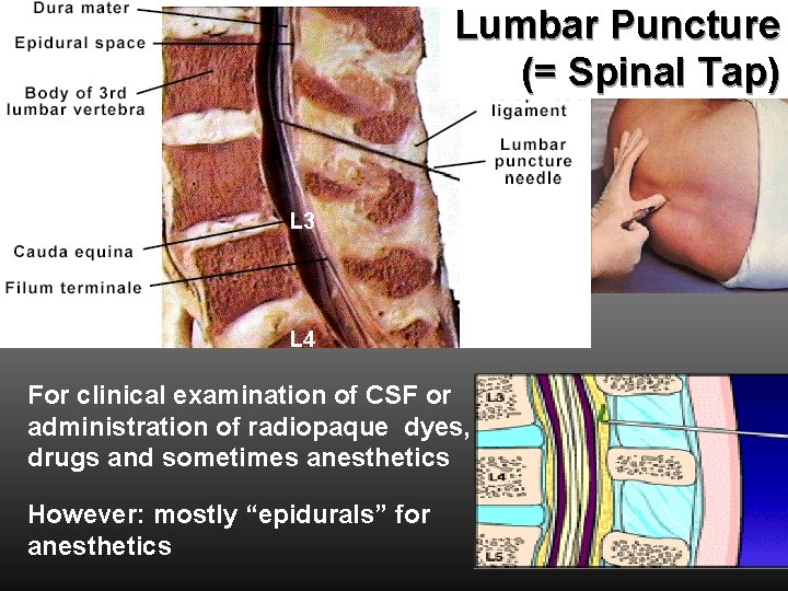 Lumbar Puncture (= Spinal Tap) L 3 L 4 For clinical examination of CSF