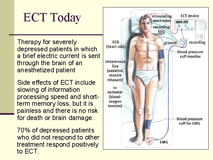 ECT Today Therapy for severely depressed patients in which a brief electric current is
