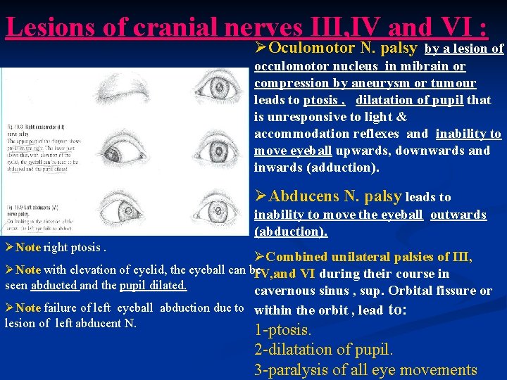 Lesions of cranial nerves III, IV and VI : ØOculomotor N. palsy by a