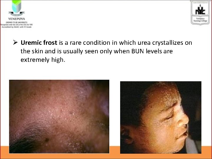 Ø Uremic frost is a rare condition in which urea crystallizes on the skin