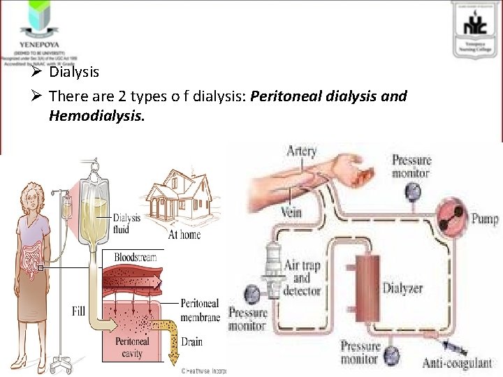 Ø Dialysis Ø There are 2 types o f dialysis: Peritoneal dialysis and Hemodialysis.