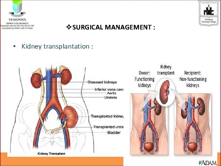 v. SURGICAL MANAGEMENT : • Kidney transplantation : 