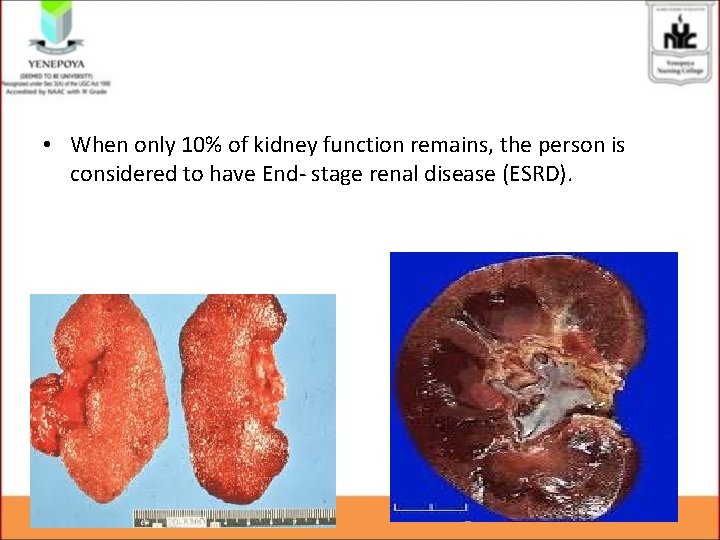  • When only 10% of kidney function remains, the person is considered to