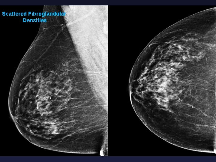 Scattered Fibroglandular Densities 