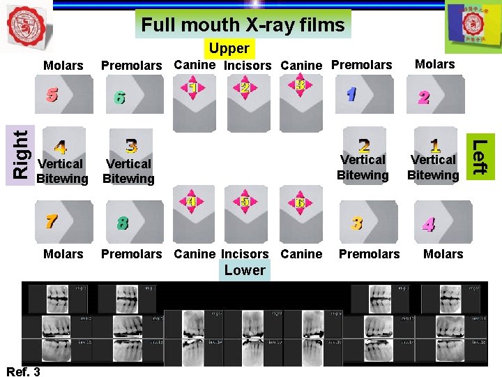 Full mouth X-ray films Upper Vertical Bitewing Molars Premolars Canine Incisors Canine Premolars Vertical