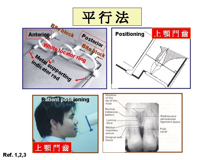 Bit e Anterior 平行法 blo ck Po ste rio Wh r B ite loc