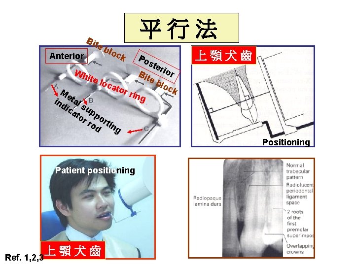 Bit e Anterior 平行法 blo ck Po ste rio Wh r B ite loc