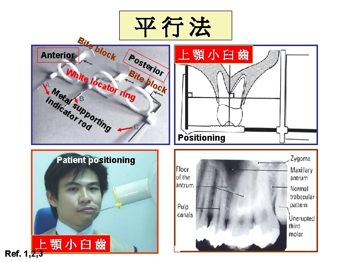 Bit e Anterior 平行法 blo ck Po ste rio Wh r B ite loc