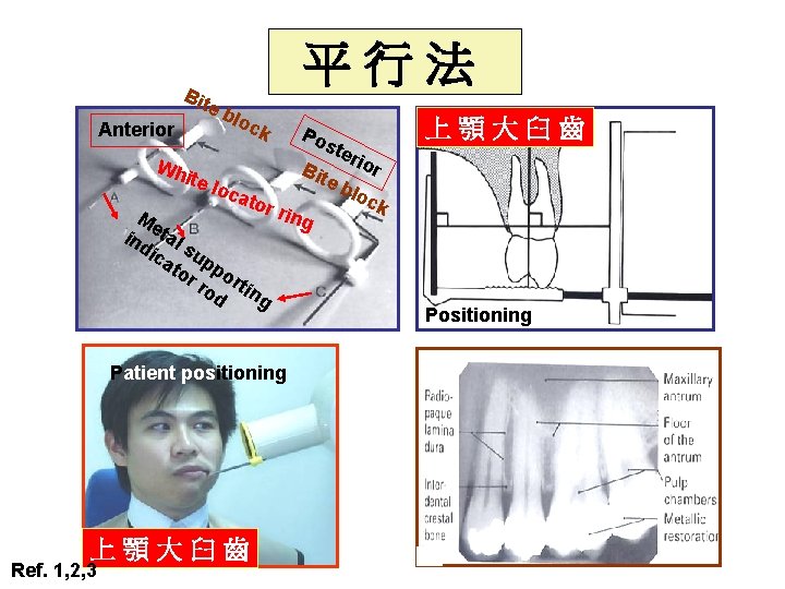 Bit e Anterior 平行法 blo ck Po ste rio Wh r B ite loc