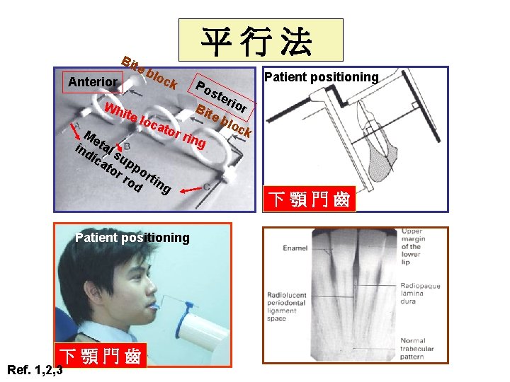 Bit e Anterior 平行法 blo ck Po ste rio Wh r B ite loc