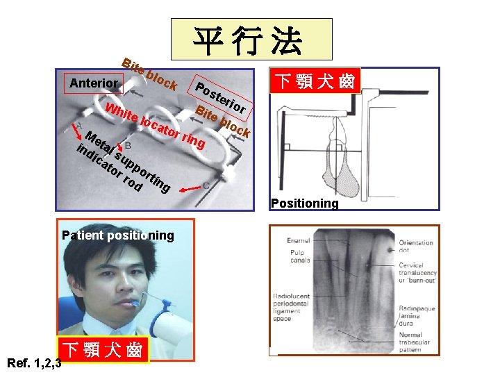 Bit e Anterior 平行法 blo c k Po ste rio Wh r B ite