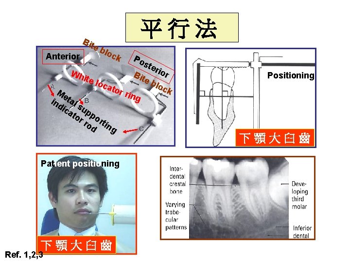 Bit e Anterior 平行法 blo c k Po ste rio Wh r B ite