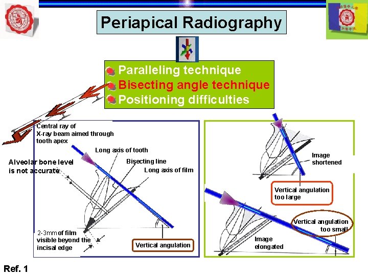 Periapical Radiography Paralleling technique Bisecting angle technique Positioning difficulties Central ray of X-ray beam