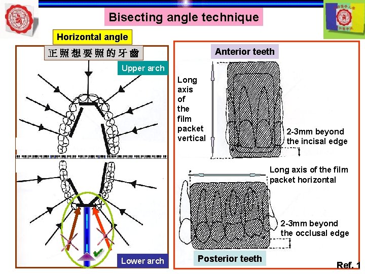 Bisecting angle technique Horizontal angle Anterior teeth 正照想要照的牙齒 Upper arch Long axis of the