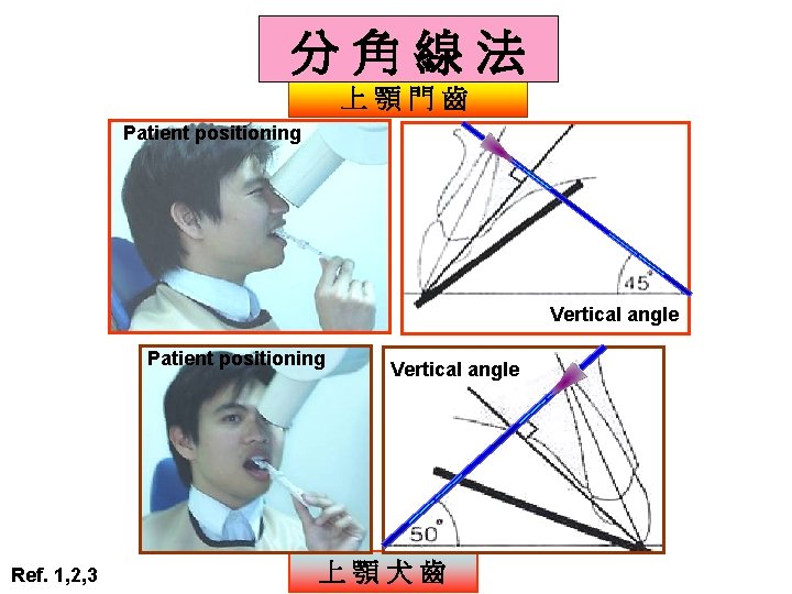 分角線法 上顎門齒 Patient positioning Vertical angle Patient positioning Ref. 1, 2, 3 Vertical angle