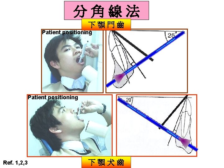 分角線法 下顎門齒 Patient positioning Ref. 1, 2, 3 下顎犬齒 