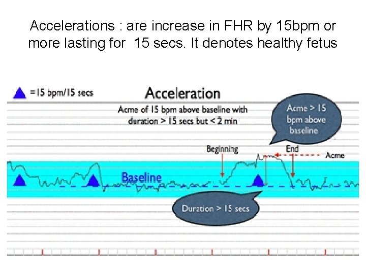 Accelerations : are increase in FHR by 15 bpm or more lasting for 15