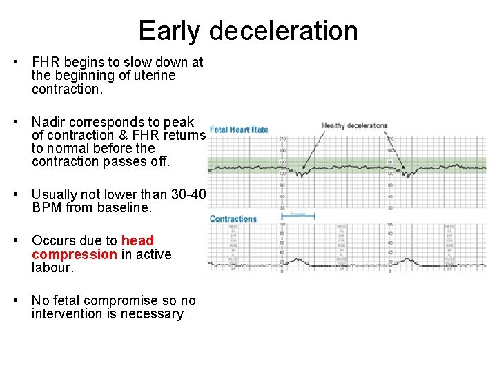 Early deceleration • FHR begins to slow down at the beginning of uterine contraction.