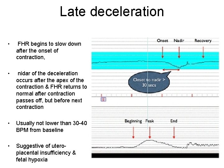 Late deceleration • FHR begins to slow down after the onset of contraction, •
