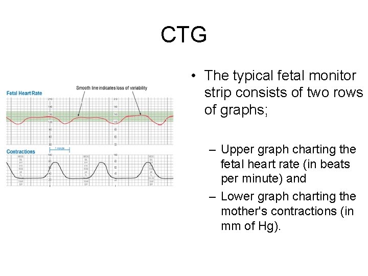 CTG • The typical fetal monitor strip consists of two rows of graphs; –
