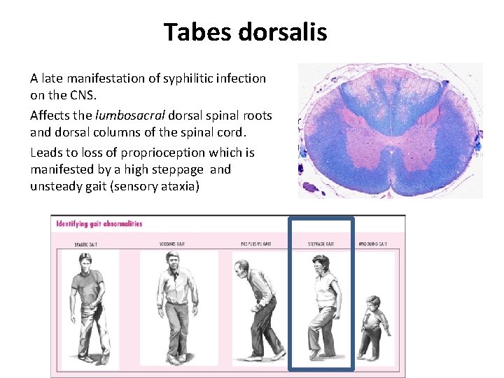 Tabes dorsalis A late manifestation of syphilitic infection on the CNS. Affects the lumbosacral