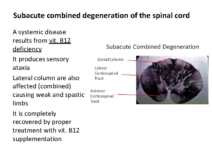 Subacute combined degeneration of the spinal cord A systemic disease results from vit. B