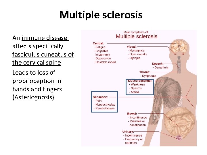 Multiple sclerosis An immune disease affects specifically fasciculus cuneatus of the cervical spine Leads