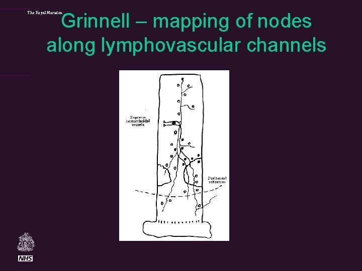 Grinnell – mapping of nodes along lymphovascular channels The Royal Marsden 