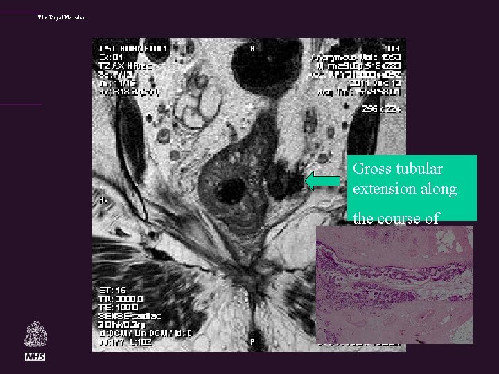 The Royal Marsden Gross tubular extension along the course of lateral rectal vein 