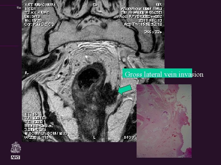 The Royal Marsden Gross lateral vein invasion 