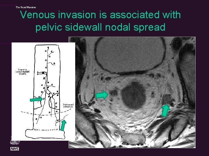 The Royal Marsden Venous invasion is associated with pelvic sidewall nodal spread 