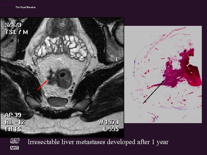 The Royal Marsden Irresectable liver metastases developed after 1 year 